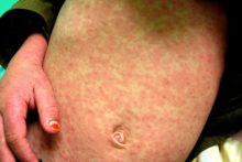 Over a quarter of all cases of measles in England and Wales last year were recorded in the Merseyside area.