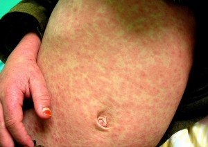 A case of measles © Teseum/CreativeCommons/Flickr